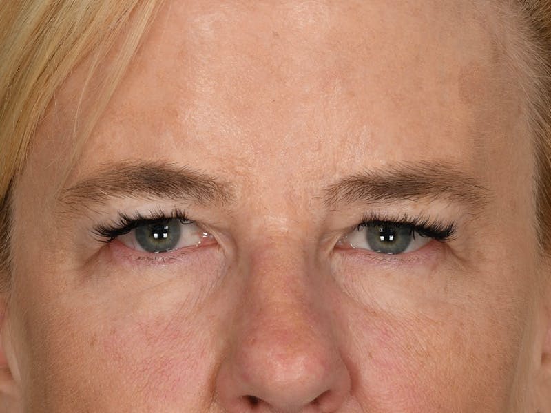 Blepharoplasty Before & After Gallery - Patient 378474 - Image 1