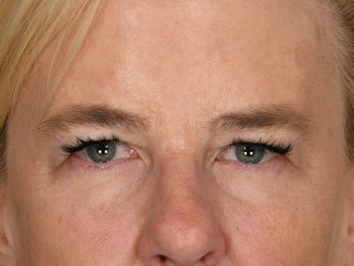 Blepharoplasty Before & After Gallery - Patient 378474 - Image 1