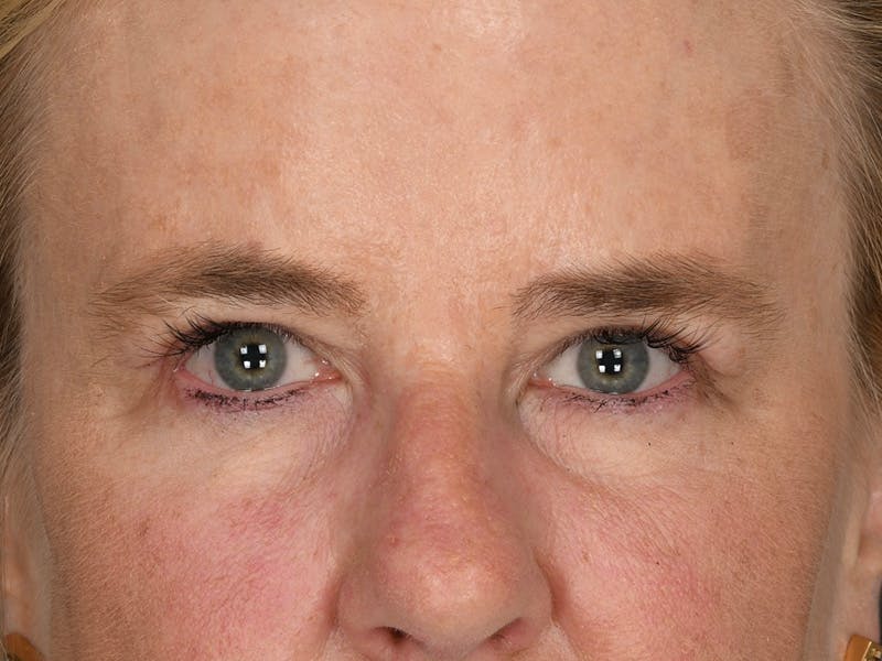 Blepharoplasty Before & After Gallery - Patient 378474 - Image 2