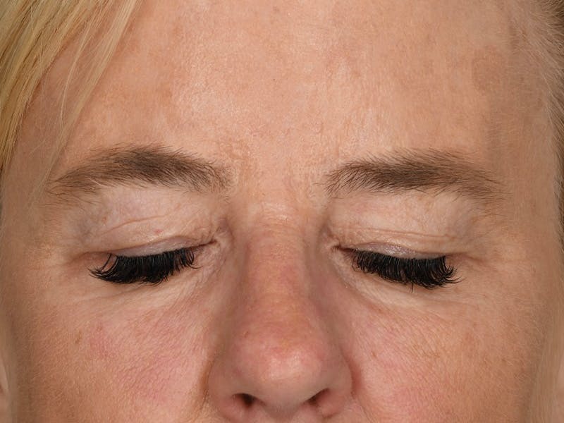 Blepharoplasty Before & After Gallery - Patient 378474 - Image 3