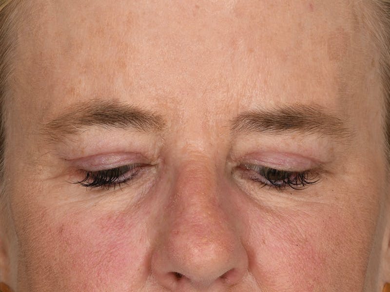 Blepharoplasty Before & After Gallery - Patient 378474 - Image 4