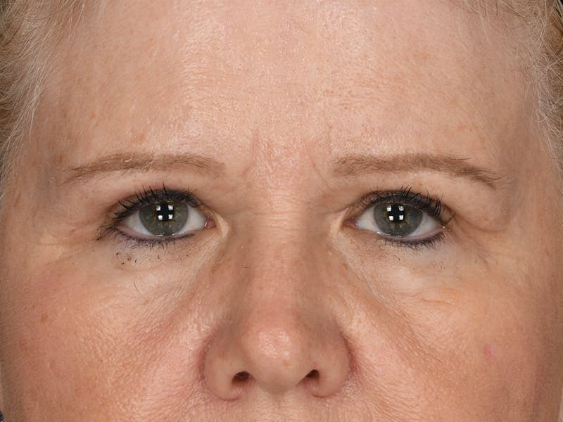 Blepharoplasty Before & After Gallery - Patient 230118 - Image 2