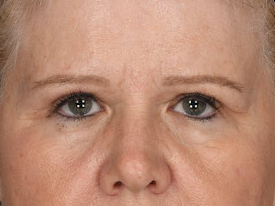 Blepharoplasty Before & After Gallery - Patient 230118 - Image 2