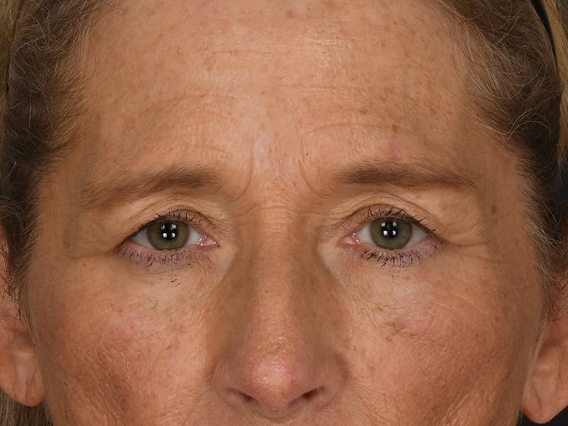 Blepharoplasty Before & After Gallery - Patient 179453 - Image 1