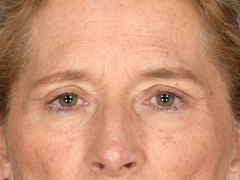 Blepharoplasty Before & After Gallery - Patient 179453 - Image 2