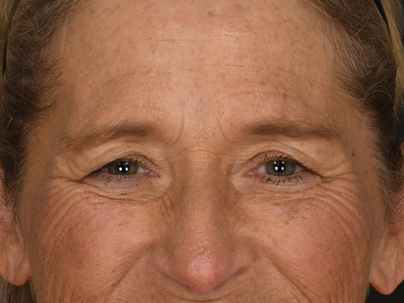 Blepharoplasty Before & After Gallery - Patient 179453 - Image 3