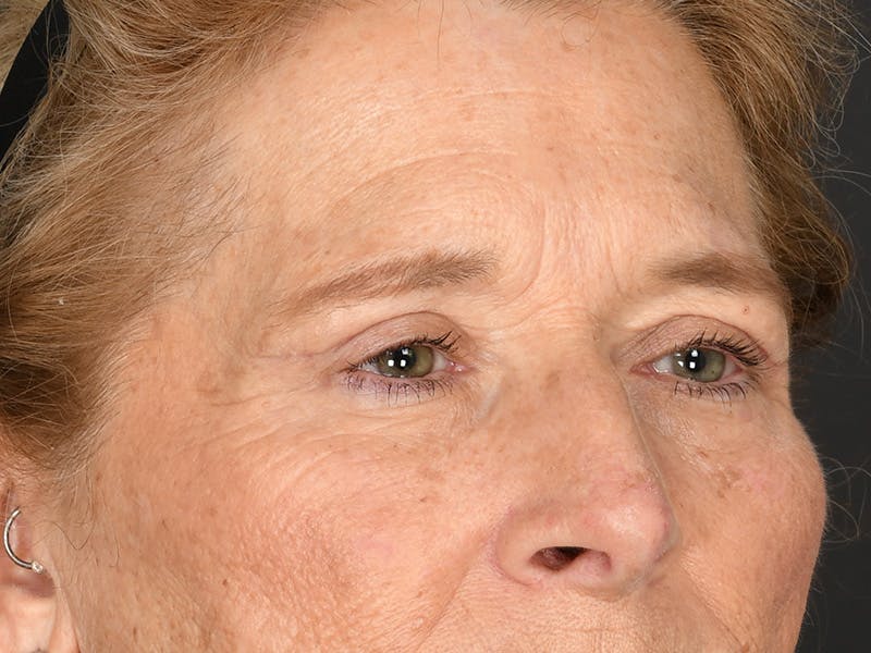 Blepharoplasty Before & After Gallery - Patient 179453 - Image 6