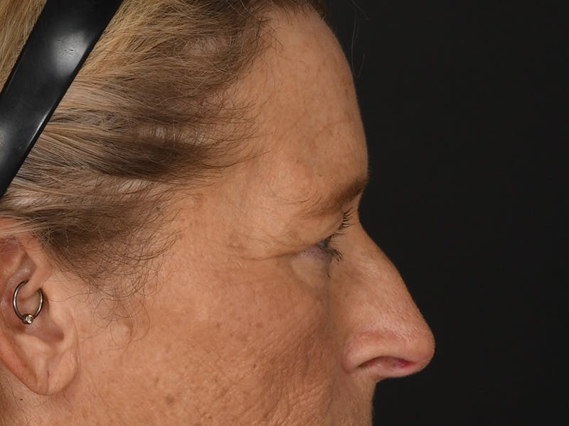 Blepharoplasty Before & After Gallery - Patient 179453 - Image 7