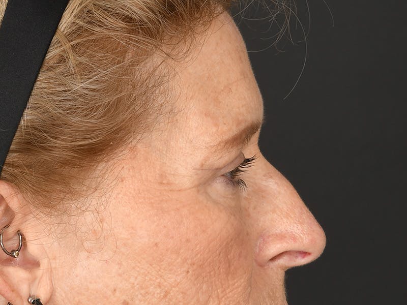 Blepharoplasty Before & After Gallery - Patient 179453 - Image 8