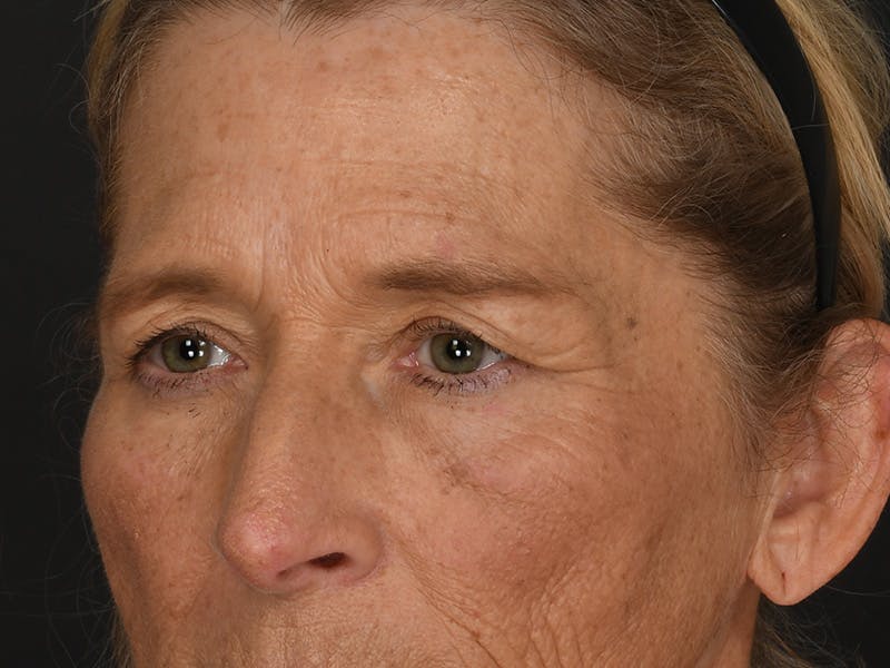 Blepharoplasty Before & After Gallery - Patient 179453 - Image 9