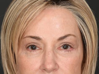 Blepharoplasty Before & After Gallery - Patient 204982 - Image 2