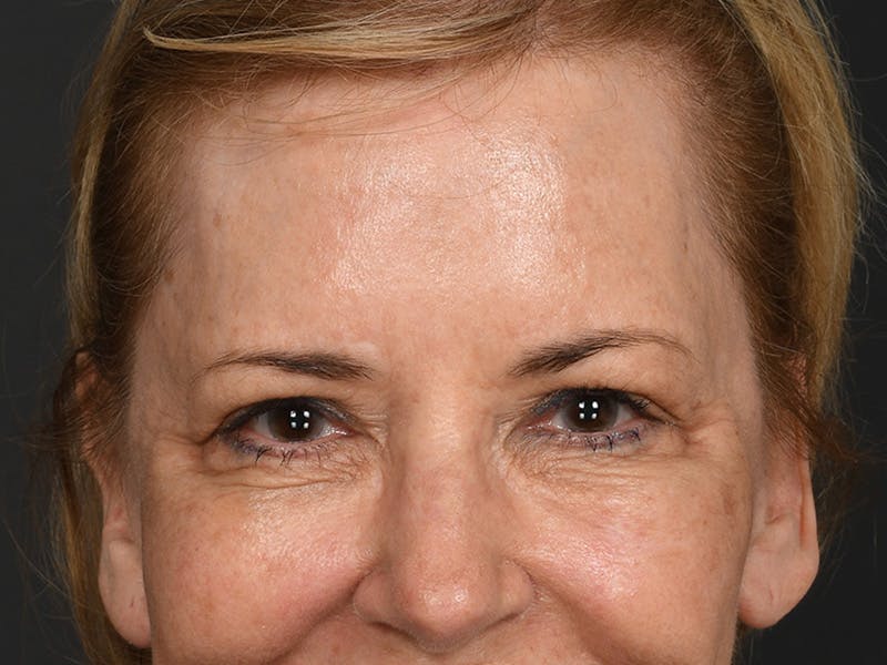 Blepharoplasty Before & After Gallery - Patient 204982 - Image 3