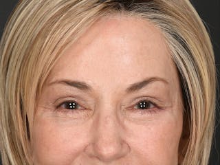 Blepharoplasty Before & After Gallery - Patient 204982 - Image 4