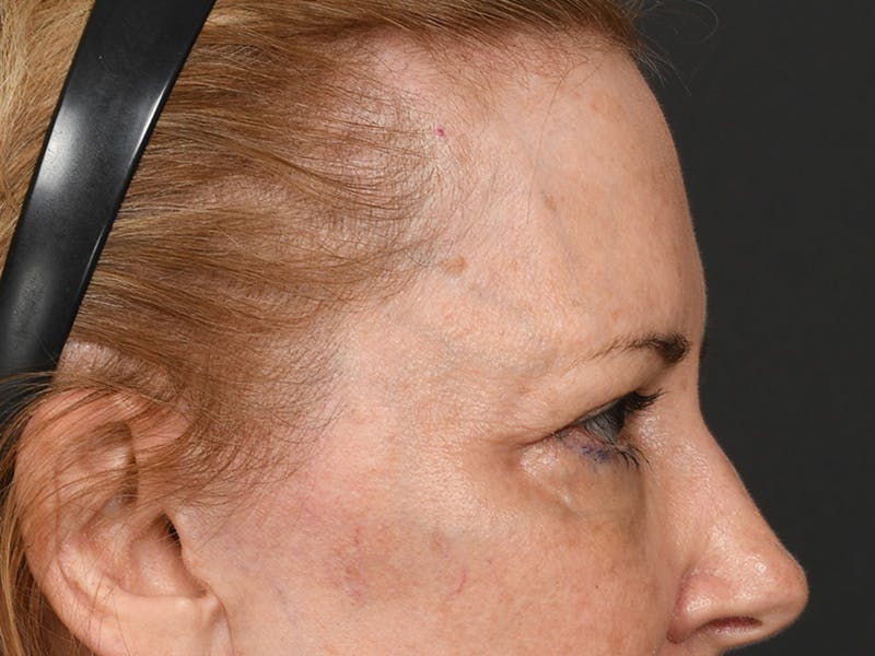 Blepharoplasty Before & After Gallery - Patient 204982 - Image 7