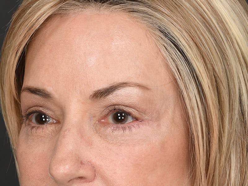 Blepharoplasty Before & After Gallery - Patient 204982 - Image 10