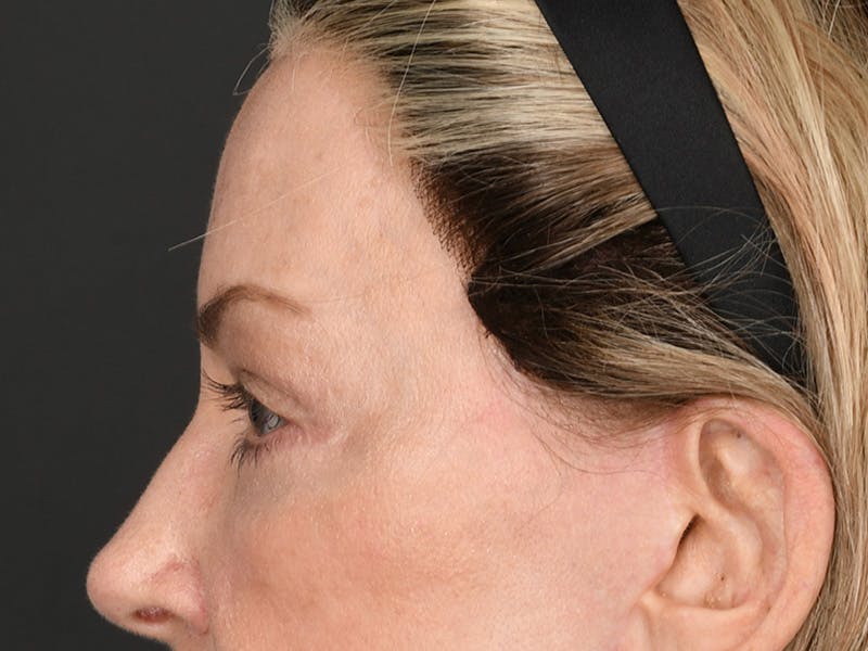 Blepharoplasty Before & After Gallery - Patient 204982 - Image 12