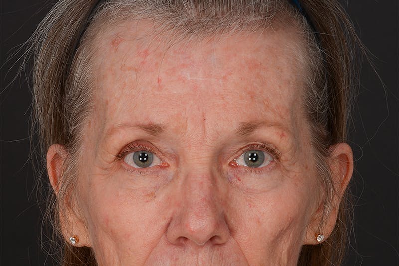 Blepharoplasty Before & After Gallery - Patient 206695 - Image 1