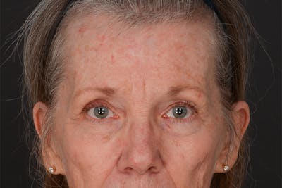 Blepharoplasty Before & After Gallery - Patient 206695 - Image 1