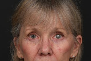 Blepharoplasty Before & After Gallery - Patient 206695 - Image 2