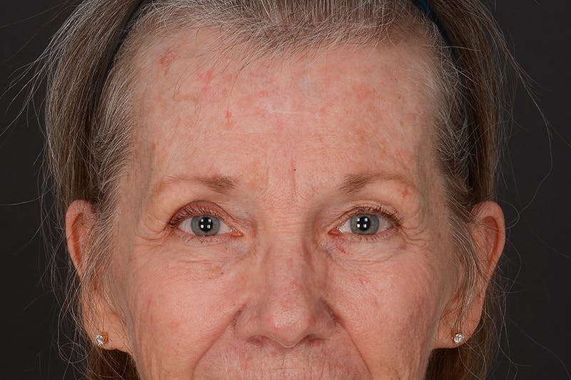 Blepharoplasty Before & After Gallery - Patient 206695 - Image 3