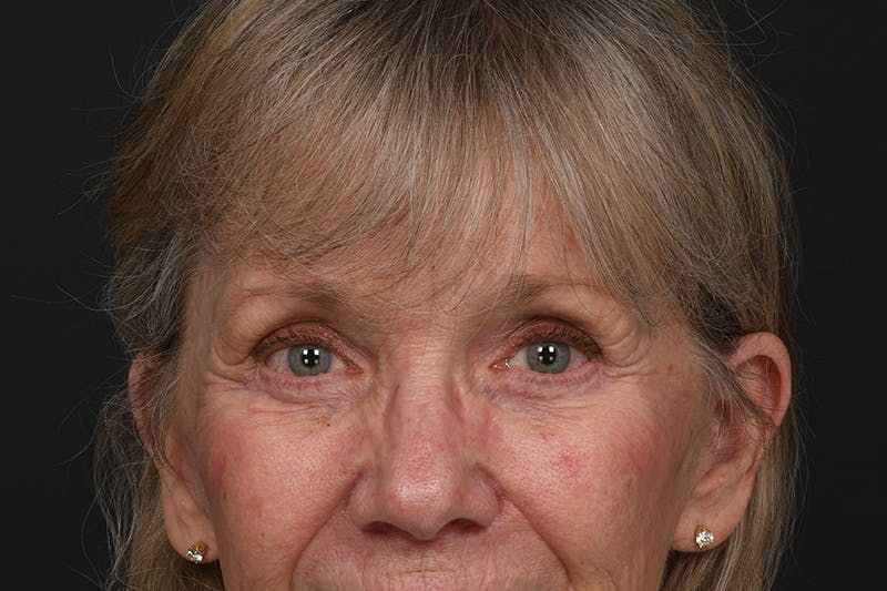 Blepharoplasty Before & After Gallery - Patient 206695 - Image 4