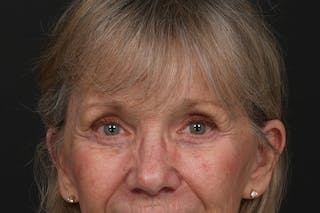 Blepharoplasty Before & After Gallery - Patient 206695 - Image 4