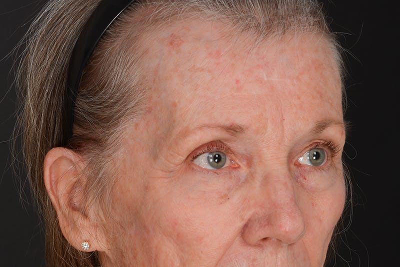 Blepharoplasty Before & After Gallery - Patient 206695 - Image 5