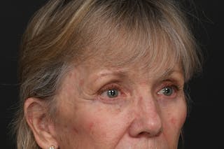Blepharoplasty Before & After Gallery - Patient 206695 - Image 6