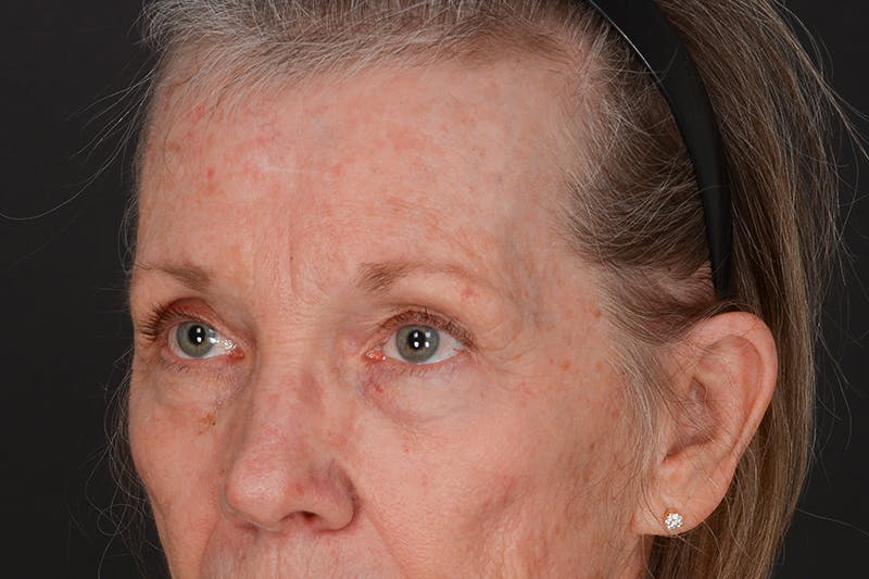 Blepharoplasty Before & After Gallery - Patient 206695 - Image 7
