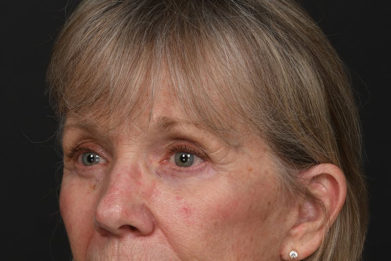 Blepharoplasty Before & After Gallery - Patient 206695 - Image 8