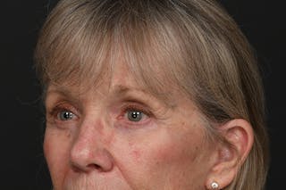 Blepharoplasty Before & After Gallery - Patient 206695 - Image 8
