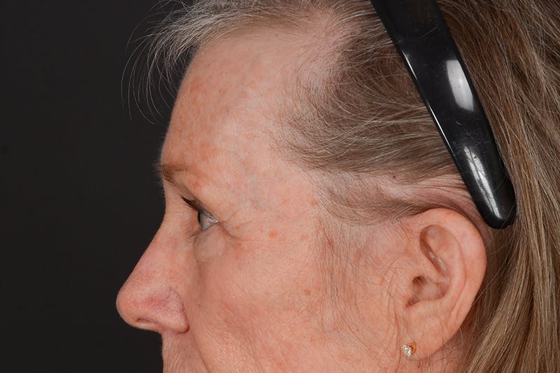 Blepharoplasty Before & After Gallery - Patient 206695 - Image 9