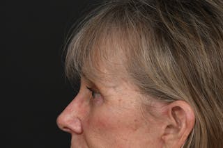 Blepharoplasty Before & After Gallery - Patient 206695 - Image 10