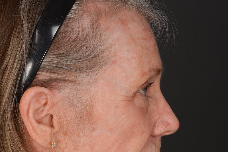 Blepharoplasty Before & After Gallery - Patient 206695 - Image 11