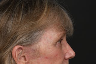 Blepharoplasty Before & After Gallery - Patient 206695 - Image 12