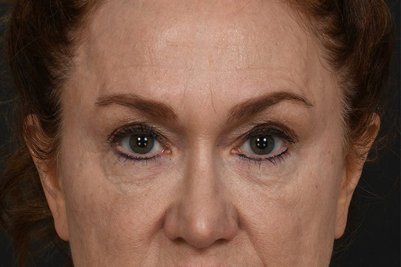 Blepharoplasty Before & After Gallery - Patient 239650 - Image 1
