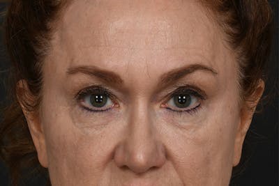 Blepharoplasty Before & After Gallery - Patient 239650 - Image 1