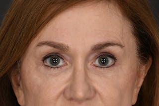 Blepharoplasty Before & After Gallery - Patient 239650 - Image 2