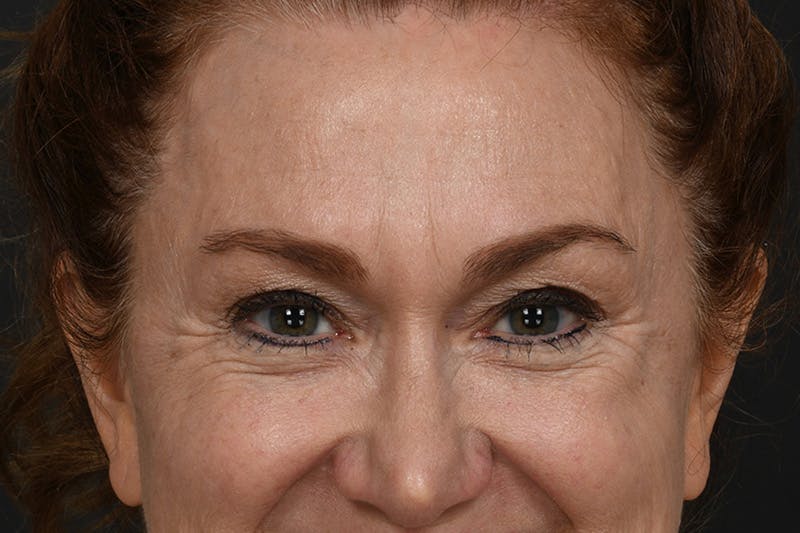 Blepharoplasty Before & After Gallery - Patient 239650 - Image 3