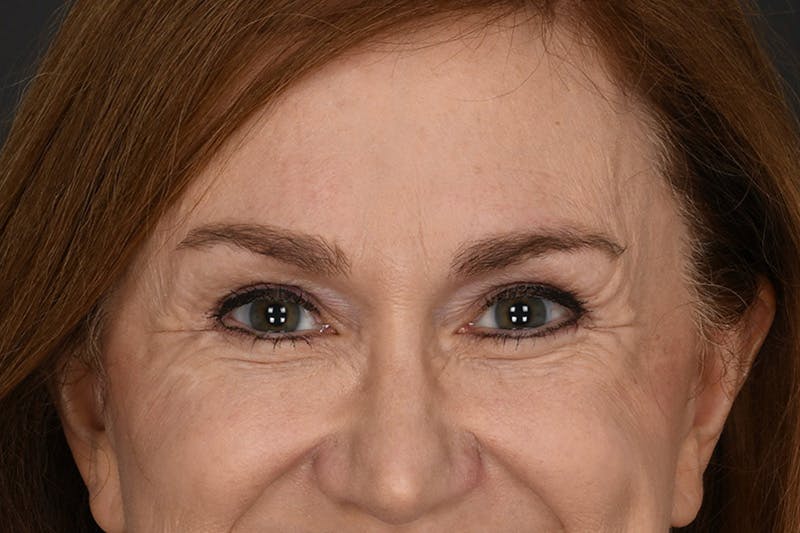 Blepharoplasty Before & After Gallery - Patient 239650 - Image 4