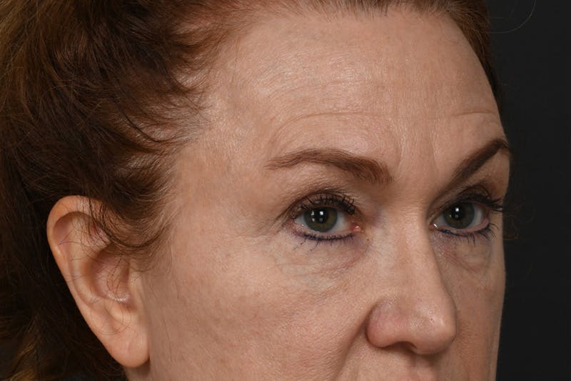 Blepharoplasty Before & After Gallery - Patient 239650 - Image 5