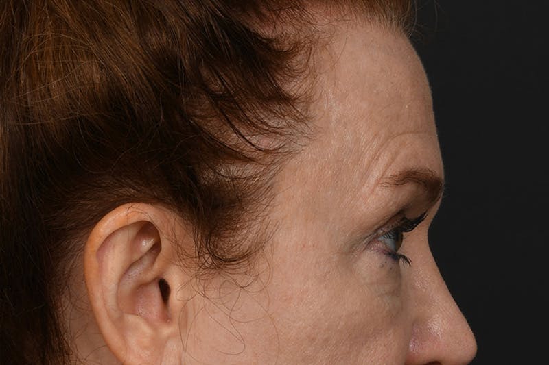 Blepharoplasty Before & After Gallery - Patient 239650 - Image 7