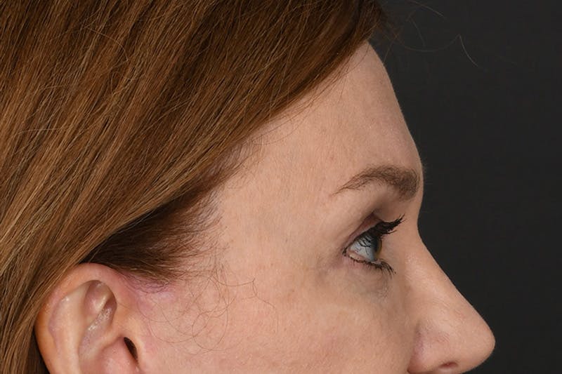 Blepharoplasty Before & After Gallery - Patient 239650 - Image 8