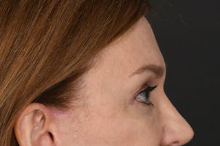 Blepharoplasty Before & After Gallery - Patient 239650 - Image 8