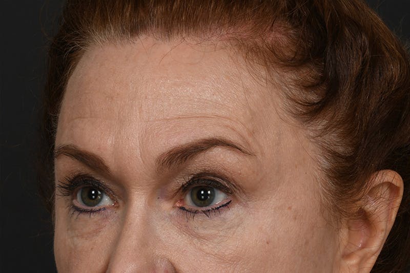 Blepharoplasty Before & After Gallery - Patient 239650 - Image 9