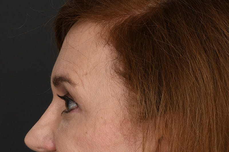 Blepharoplasty Before & After Gallery - Patient 239650 - Image 12