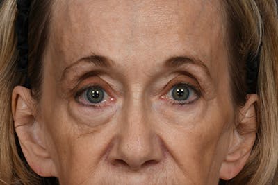 Blepharoplasty Before & After Gallery - Patient 397722 - Image 1