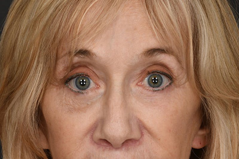 Blepharoplasty Before & After Gallery - Patient 397722 - Image 2