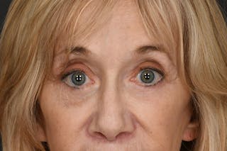 Blepharoplasty Before & After Gallery - Patient 397722 - Image 2