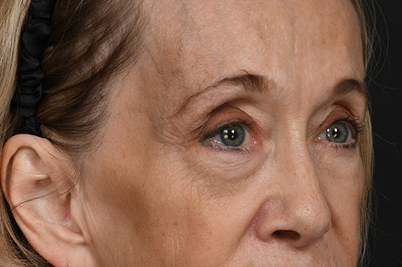 Blepharoplasty Before & After Gallery - Patient 397722 - Image 3